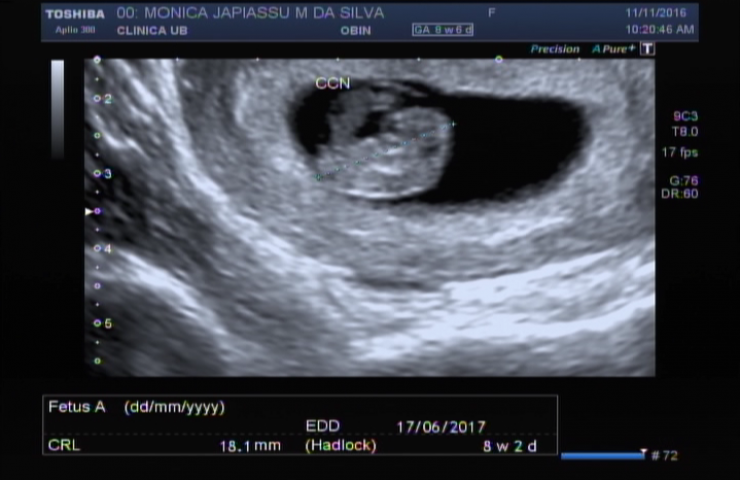 Featured image of post Imagens Gravidez 2 Meses - Ao longo dos primeiros 3 meses da gravidez, o embrião atravessa uma fase de desenvolvimento crucial para a sua sobrevivência.